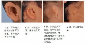 桐城的朋友问耳道都闭锁了，还能戴助听器？